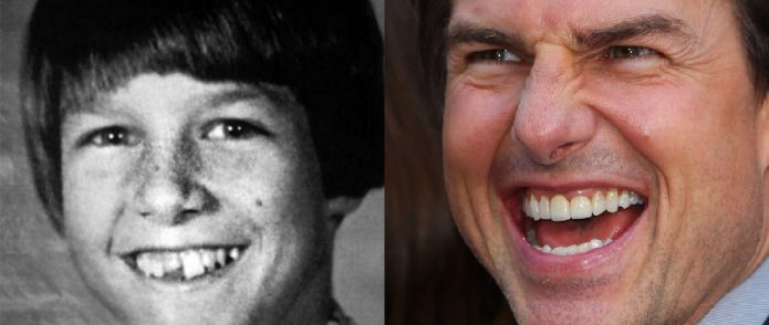Τα δόντια του Tom Cruise πριν και μετά