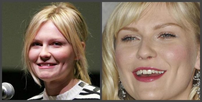 Δόντια Kirsten Dunst