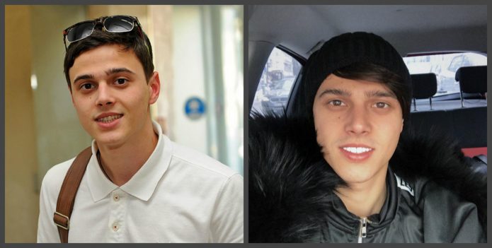 Alekseev δόντια πριν και μετά