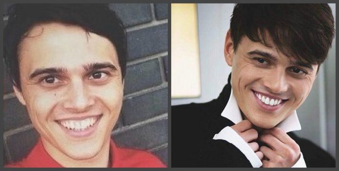 Alekseev δόντια πριν και μετά