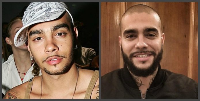 Τα δόντια του Timati πριν και μετά
