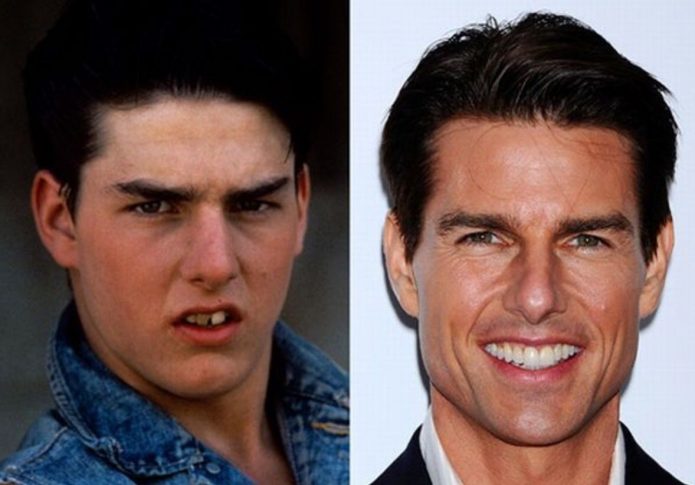 Τα δόντια του Tom Cruise πριν και μετά