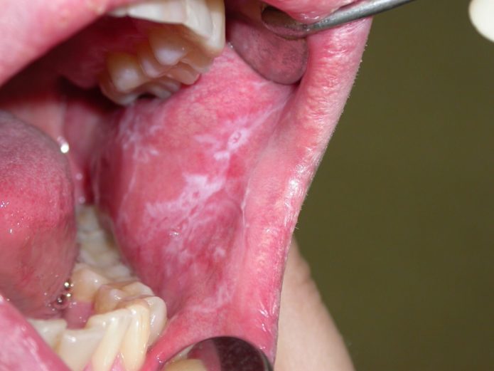 Leukoplakia από του στόματος