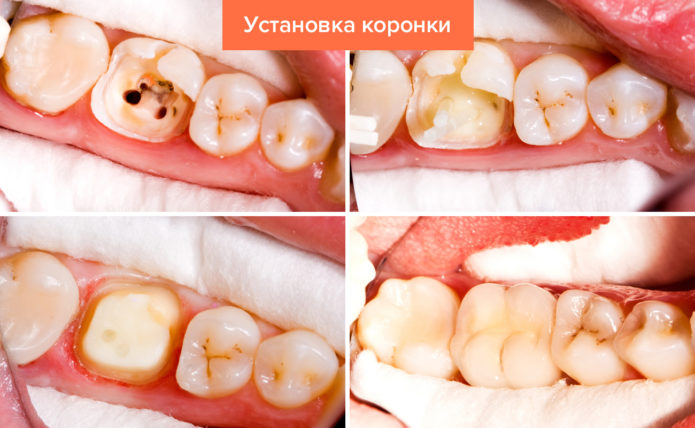 Εγκατάσταση Crown