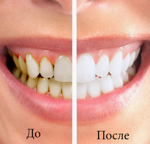 AirFlow whitening δοντιών: διαδικασίες τεχνολογίας, αξιολογήσεις