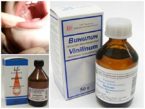 Το θετικό αποτέλεσμα της Vinilina στη θεραπεία της στοματίτιδας