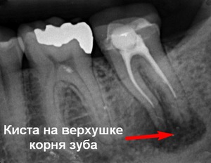Η θεραπεία μιας κύστης σε ένα δόντι αρχίζει με διάγνωση ακτίνων Χ.