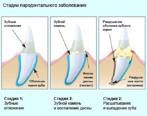 Πώς αναπτύσσεται η περιοδοντίτιδα