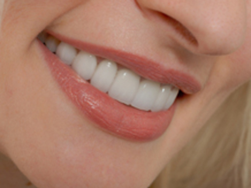 Smile Transformation-κεραμικά καπλαμάδες Χαμόγελο του Χόλιγουντ με καπλαμάδες