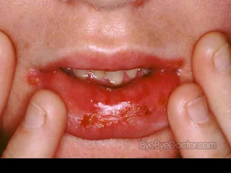 Herpetic (έρπης) στοματίτιδα σε παιδιά και ενήλικες Πώς να θεραπεύσει λοιμώδη στοματίτιδα