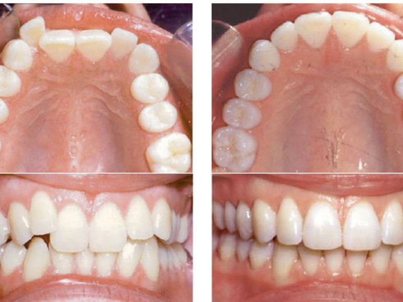 Αποτέλεσμα Ivisalign Braces