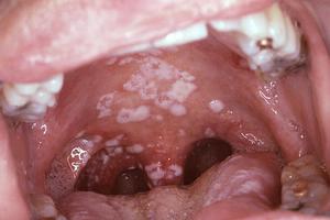 Candida stomatitis: συμπτώματα
