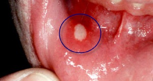 Η Aphta ονομάζεται έλκος που εμφανίζεται κατά τη διάρκεια της στοματίτιδας.