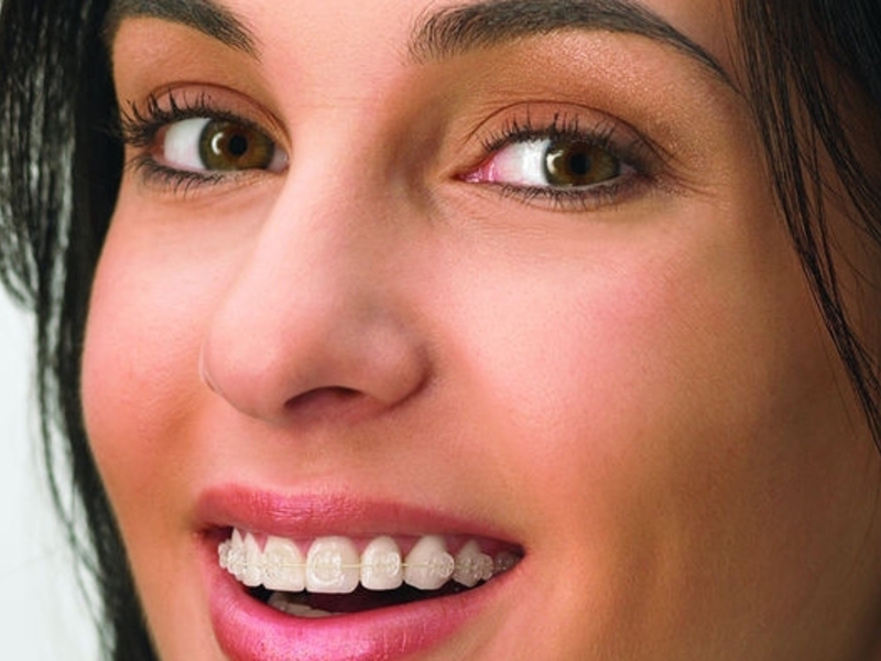 Radiance Sapphire Braces Κορίτσια ζαφείρι κορίτσι