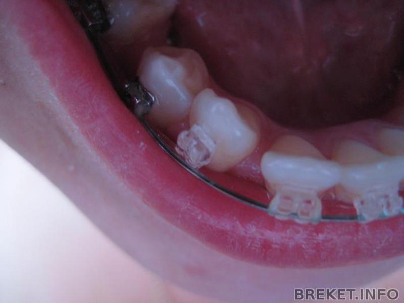 Sapphire Brace μετατοπισμένο Fang Όμορφα τιράντες ζαφείρι