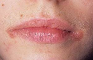 Τι είναι cheilitis στα χείλη