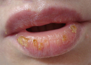 Τύπος νόσου cheilitis