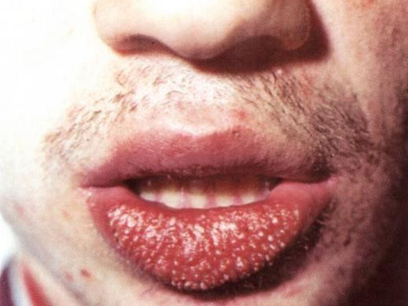 Heylita στα χείλη στους ενήλικες Cheilitis σε ενήλικες