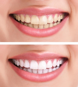 Μέθοδος λεύκανσης δοντιών