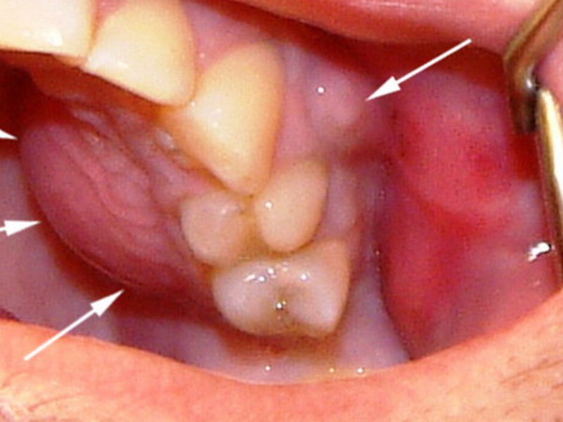 Serous periostitis